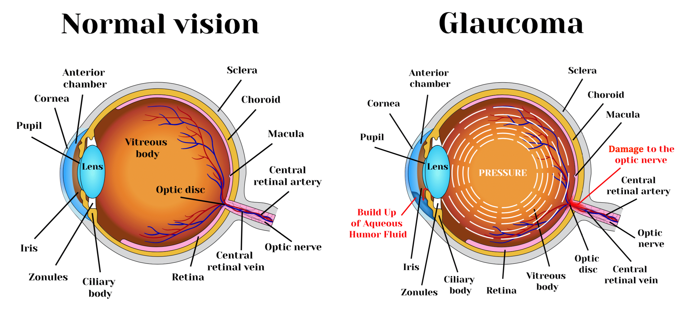 Low vision awareness month; Glaucoma. 