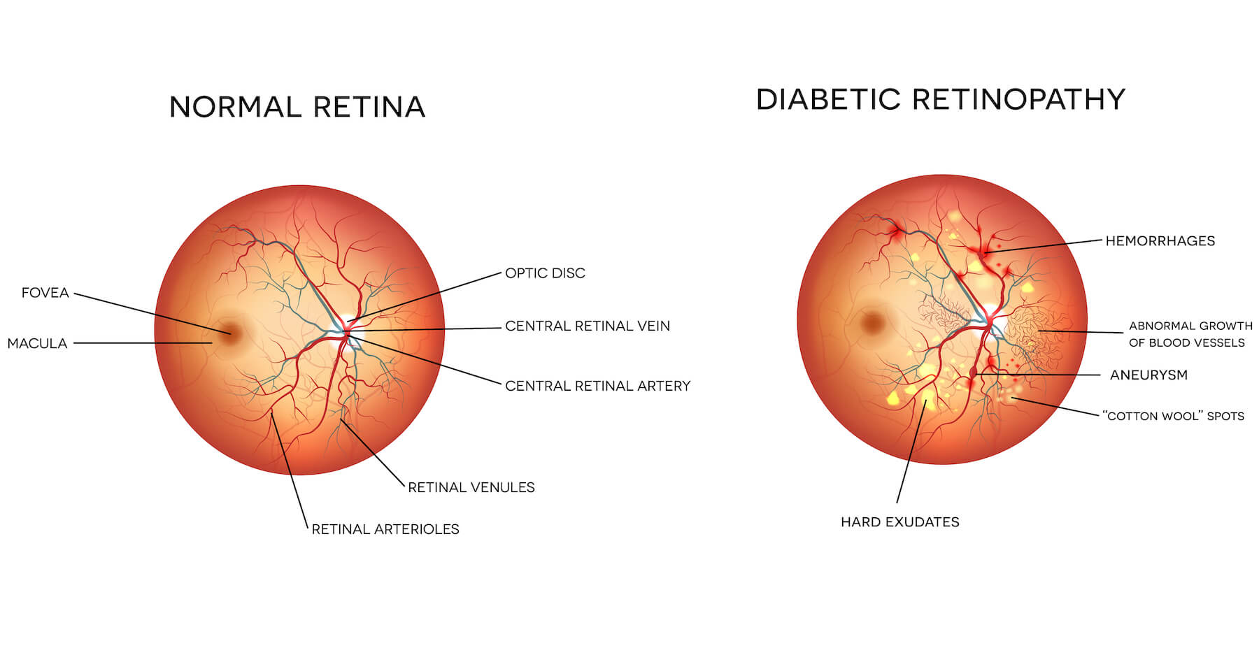 Diabetes and sight loss
