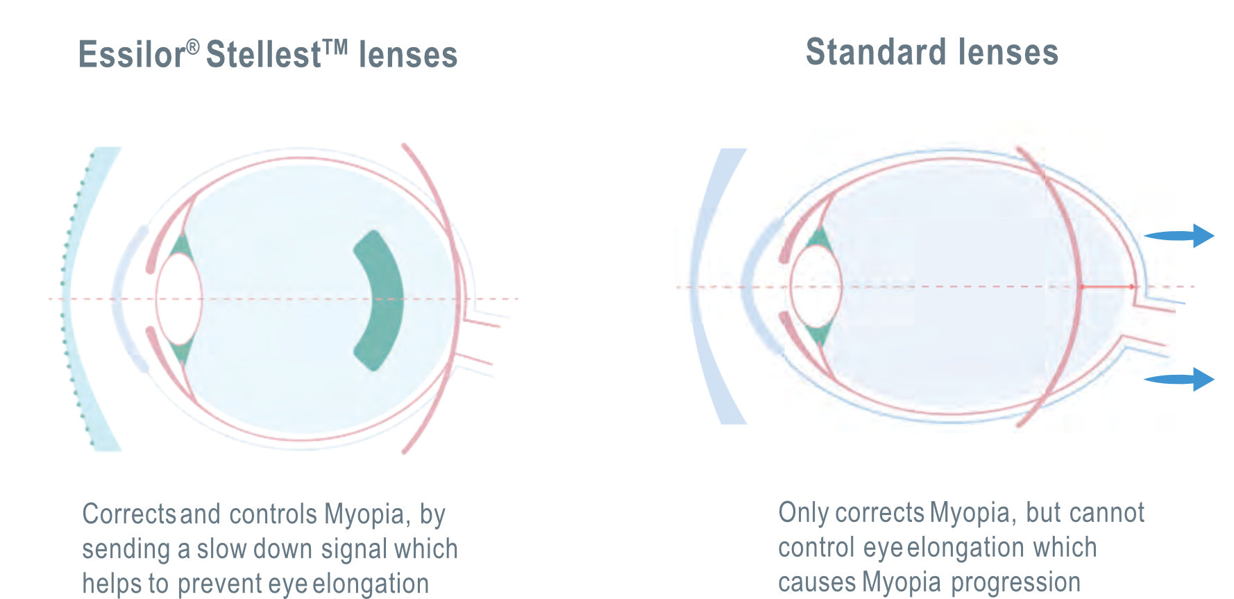 Myopia Management, What is it and how does it work?