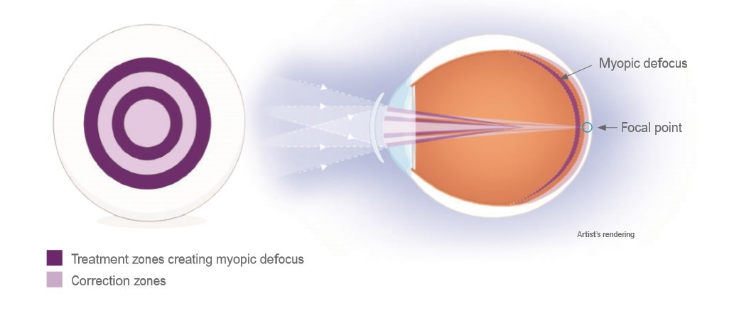 Myopia Management, What is it and how does it work?